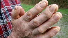 Denosumab May Halt Erosive Hand Osteoarthritis Progression