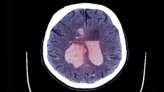 Thrombectomy Benefits Stroke With Large Core Volumes: SELECT