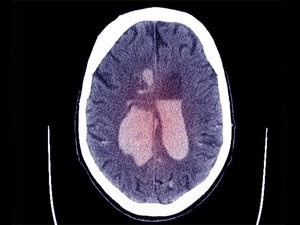 Thrombectomy Benefits Stroke With Large Core Volumes: SELECT2