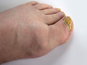 Expert Shares Her Tips for Diagnosing, Treating Onychomycosis