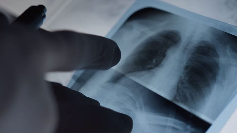 Room for Optimism: Treating Metastatic NSCLC: Ben