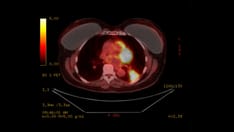 NSCLC e-Tumor Boards: Case 8: Resectable NSCLC With Comorbid Rheumatoid Arthritis