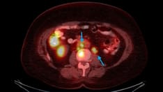 Breast Cancer e-Tumor Boards: Case 4: ER+ mBC with Multiple Targetable Mutations