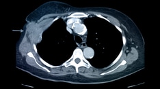 Breast Cancer e-Tumor Boards: Case 5: Metastatic High-Grade Neuroendocrine Carcinoma