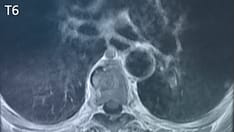 Breast Cancer e-Tumor Boards: Case 6: ER+ mBC with BRAF V600E Mutation