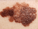 Melanoma Review: Background and Treatment