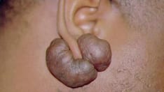 6 Body Modifications: Dermatologic Risks and Adverse Reactions