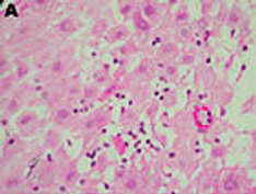 Once-Daily Doxycycline Effective Against Chlamydia