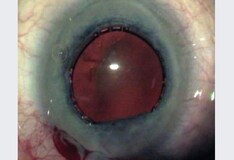Review And Update Of Intraoperative Floppy Iris Syndrome