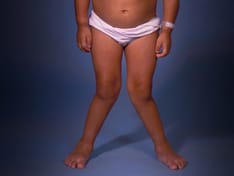 FDA's Rare Disease Program: A Rare Opportunity to Help Kids