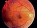 Fluocinolone Implant Slows Retinopathy in Macular Edema
