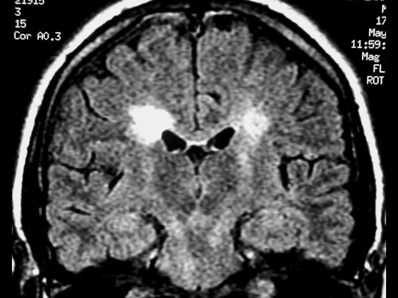 Standardizing MRI in Monitoring MS
