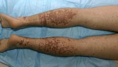 Soldier With Burning, Spreading Rash