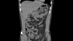 6 Months of Diarrhea