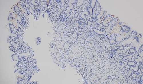 https://img.medscapestatic.com/thumbnail_library/msr_221012_helicobacter_pylori_stain_500x294.jpg