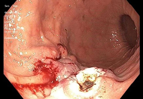 https://img.medscapestatic.com/thumbnail_library/msr_221012_ulcerated_bleeding-mass_stomach_500x346.jpg