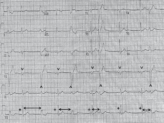 Ecg Challenge: Is Heart Disease Causing His Irregular Pulse? - Page 2