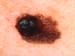 Questions Over Adjuvant Ipilimumab in Melanoma
