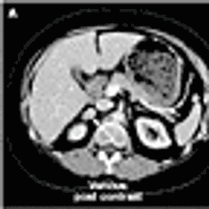 Cushing's Syndrome in Women With Polycystic Ovaries and Hyperandrogenism