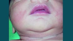 6 Common-to-Rare Infant Skin Conditions