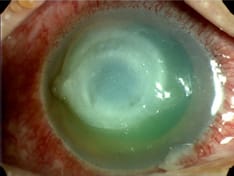 Risk Factors, Outcomes, and Prognosis of Bacterial Keratitis