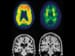 Amyloid Pattern in TBI Different Than in Alzheimer's