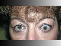 Former Cancer Drug Very Promising for Graves' Ophthalmopathy