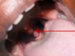 laryngeal papilloma medscape