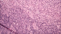 B-Cell Cancers: Sparse Insight Into Preventing Infections