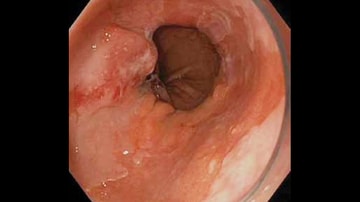 hpv barrett s esophagus)