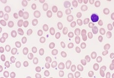 Glucose 6 Phosphate Dehydrogenase G6pd Deficiency Practice Essentials Pathophysiology Etiology