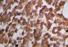 Tumor Lysis Syndrome Practice Essentials Pathophysiology Etiology