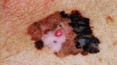 Pediatric Melanoma: Incidence, Risk Factors, and the ABCDE Rule
