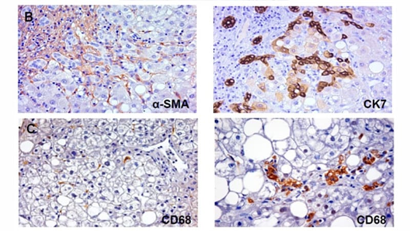How Diet and Exercise Can Help Manage NAFLD, According to the AGA