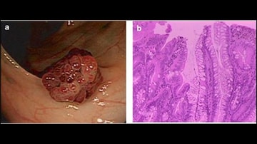 osteoarthritis pathophysiology medscape a combcsontok ízületi gyulladása