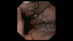 Stent Misdeployment During EUS-GE Is Not Infrequent But Manageable