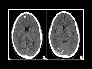 Cerebral Thrombosis After COVID Vax Deadlier Than Sporadic Form