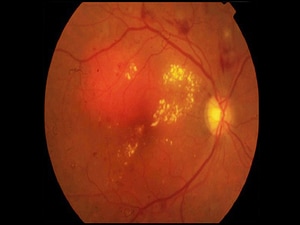 Diabetic Macular Edema: Mixed Results for Brolucizumab