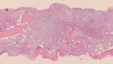 When to Treat as Important as Which Drug to Use in WM