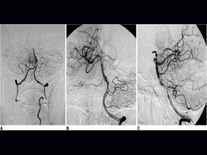 Intra-arterial tPA After Stroke Thrombectomy: 'Remarkable' Benefit