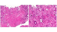 Mixed Results for Eosinophil-Depleting Drug in Eosinophilic Gastritis