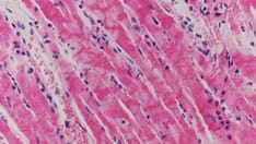 No Benefit of Anti-inflammatory Strategy in Acute Myocarditis