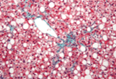 Weber-Christian Disease Treatment & Management: Medical Care, Surgical