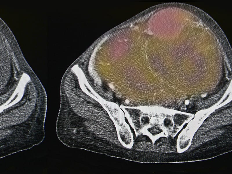 Ovarian Cancer: Recurrent Themes