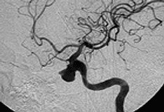 Scalp Vein Catheterization Technique: Catheterization of ...