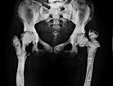 Successful Staged Hip Replacement in Septic Hip Osteoarthritis in Osteopetrosis