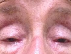 A 73-Year-Old Woman With Progressive Ptosis