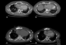 Pectus Excavatum Workup Laboratory Studies Imaging Studies Other Tests