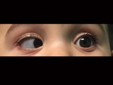 The Child With Strabismus Who Squints One Eye