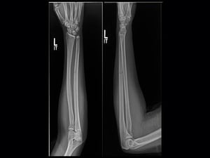 Nondisplaced Ulna Fracture Could Mean Intimate-Partner Violence